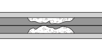 (1) Run a guide wire.