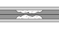 (1) Run a guide wire.