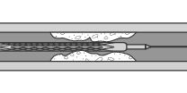 (2) Insert a balloon type catheter covered with a stent.