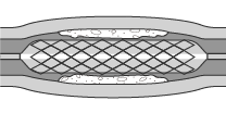(3) Inflate the balloon and crimp the stent to the vessel wall.