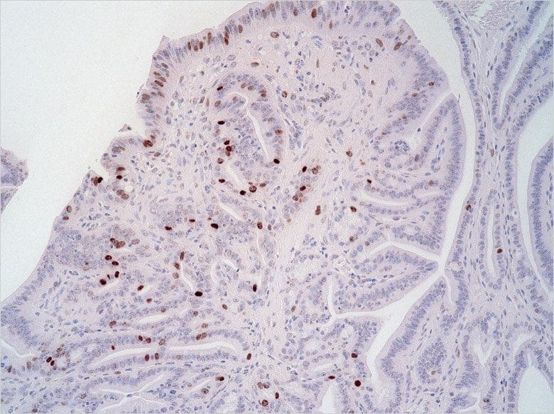 Image: Cancer cells proliferating in stomach tissue