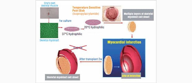 Image: Treatment using a skeletal myoblast cell sheet...