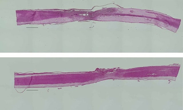 Images: The upper diagram depicts a fibroblastic cell grafted onto a damaged spinal cord...