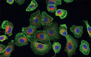 Observation of Multi-dyed Type I Alveolar Cancer Cells