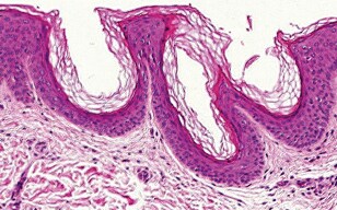 Quantitative Analysis of Skin Damage Caused by Ultraviolet Radiation