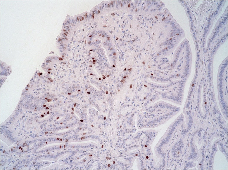 Image: Cancer cells proliferating in stomach tissue
