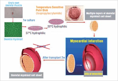 Image: Treatment using a skeletal myoblast cell sheet...